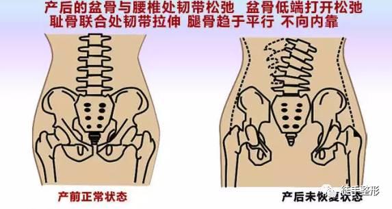 徒手整形许强分享：原来骨盆不正对女性影响这么大