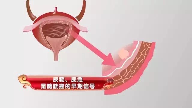 养生堂泌尿外科张耀光,北京医院泌尿外科主任张耀光