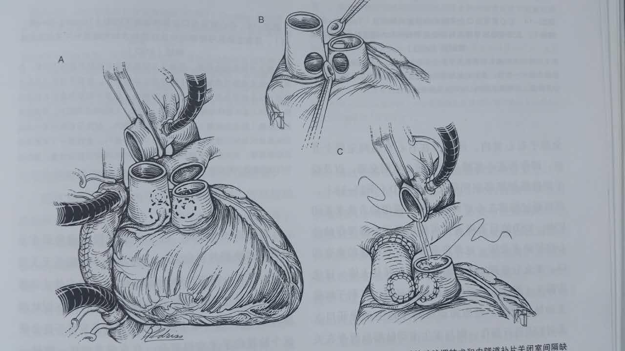 哈尔滨儿童医院能治先心病么,哈尔滨儿童医院做室缺手术