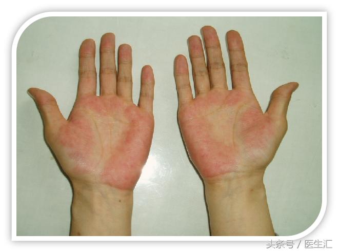 大量咯血突然停止见于什么病,间断性咯血是什么原因