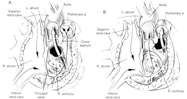 哈尔滨儿童医院能治先心病么,哈尔滨儿童医院做室缺手术