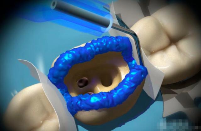 抽掉神经的牙齿有什么危害,把牙齿神经抽掉会怎么样