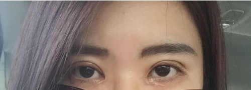 割双眼皮之后哭了会疤痕增生吗,割双眼皮后需要买疤痕药膏吗