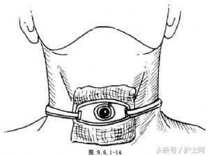 气切金属套管多久可以拔出,气切套管拔出后注意事项