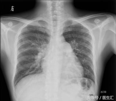 大量咯血突然停止见于什么病,间断性咯血是什么原因