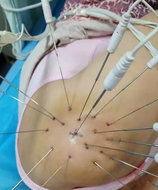 射频消融术和内热针有什么区别,内热针疗法治疗腰间盘突出