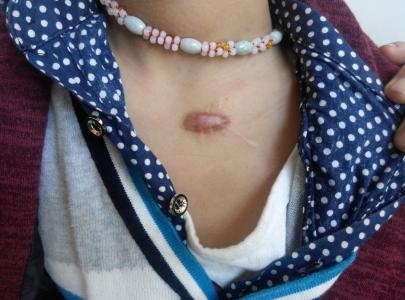 什么是瘢痕疙瘩,什么是瘢痕疙瘩消退的征兆