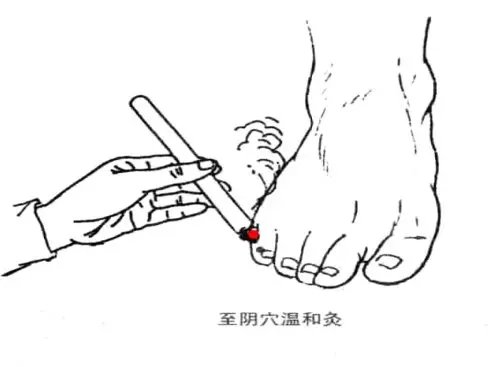 胎位不正如何纠正胎位,胎位不正纠正胎位最快方法