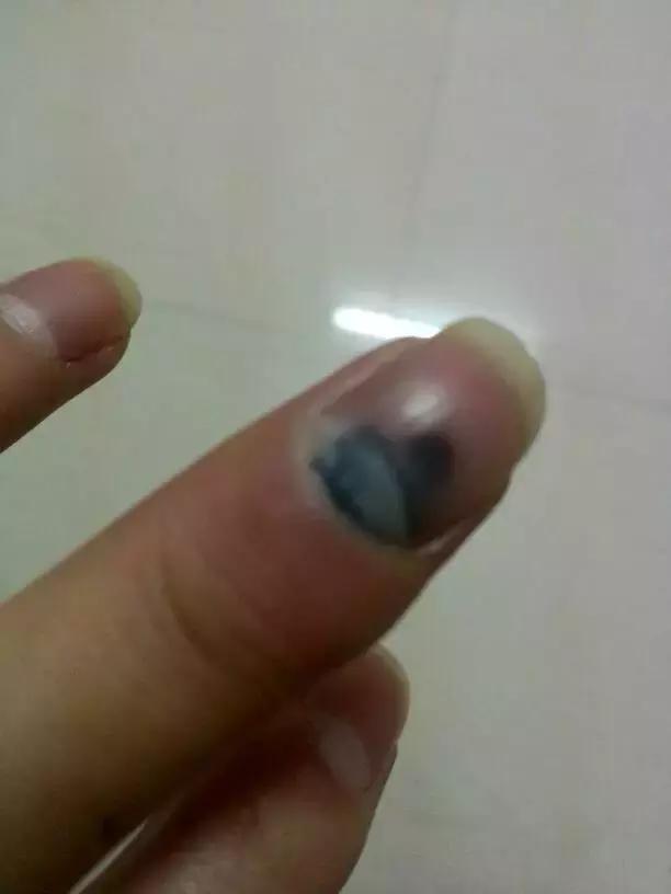 指甲根部被挫伤了怎么办,有一种痛叫做痛彻心扉