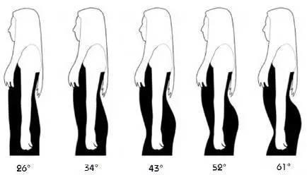 徒手整形许强分享：原来骨盆不正对女性影响这么大
