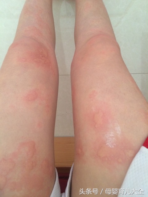 回了趟老家身上起疙瘩,宝宝回老家身上就出疙瘩怎么办