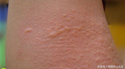 回了趟老家身上起疙瘩,宝宝回老家身上就出疙瘩怎么办