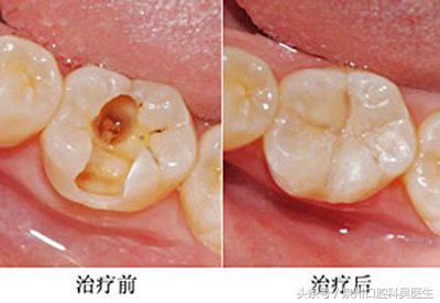 那些会让人误解的口腔小知识,大部分中国人都有的口腔问题