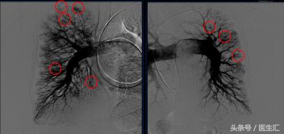 大量咯血突然停止见于什么病,间断性咯血是什么原因