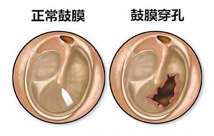 孩子游泳说耳朵里面疼是中耳炎吗,儿童游泳后耳朵里面响