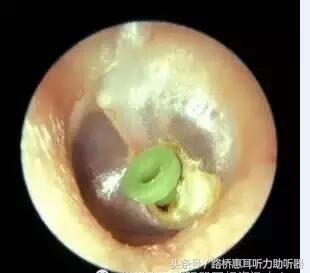 惠耳助听器温岭,台州惠耳听力助听器