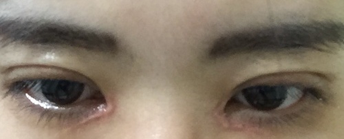 割双眼皮之后哭了会疤痕增生吗,割双眼皮后需要买疤痕药膏吗