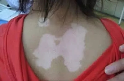 3招区别白色糠疹和白癜风,三种不容易治疗的白癜风类型