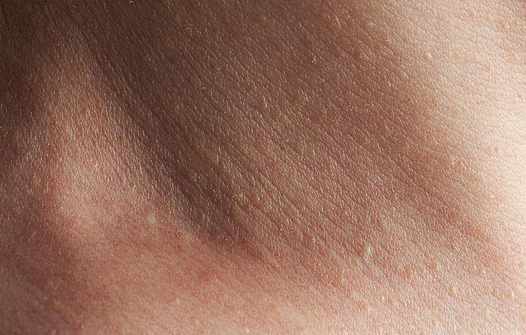 脖子突然变黑是色素沉着吗,脖子胳膊腕发黑什么原因