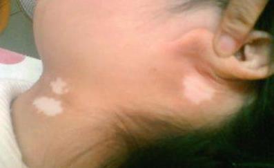 3招区别白色糠疹和白癜风,三种不容易治疗的白癜风类型