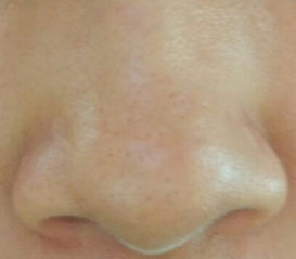 鼻子脸部挤出白色线状米粒是什么,鼻子上挤出的白色条状物到底是啥