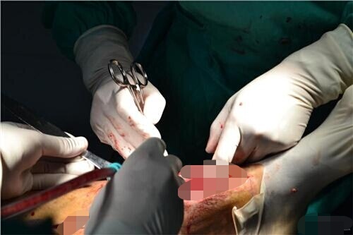 微创介入动脉瘤栓塞手术,脑部介入栓塞手术安全系数高吗