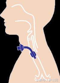 气切金属套管多久可以拔出,气切套管拔出后注意事项
