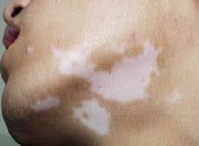 白癜风治疗出现瓶颈，多位白癜风专家“三顾茅庐”请出老中医，与其一起研究白癜风的治疗方法，成果惊人