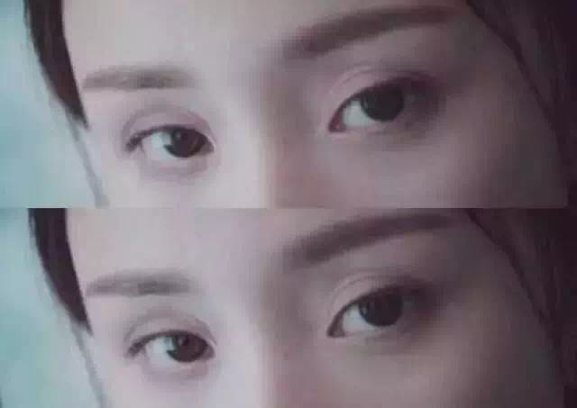 杨幂眼皮松弛怎么补救的,杨幂眼睛肿了怎么回事