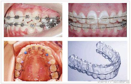正畸方案包括哪些步骤,正畸治疗最佳方案
