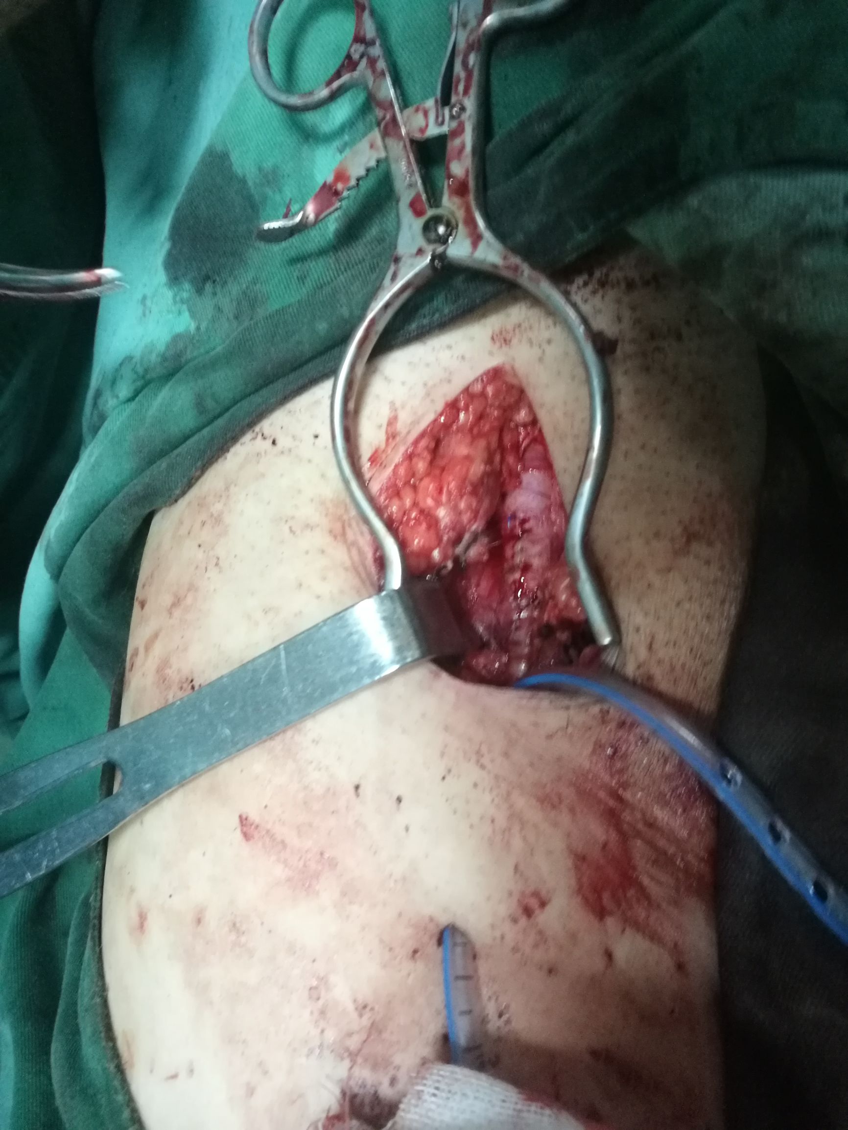 治下肢血栓闭塞脉管炎中药方,下肢动脉慢性血栓闭塞