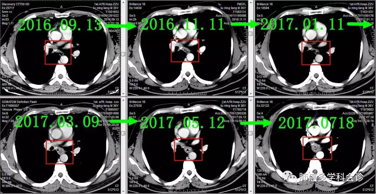 食管癌转移两侧淋巴癌严重吗,食管癌转移和扩散区别