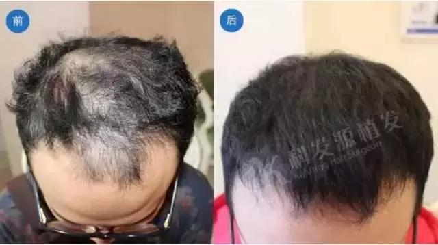 女性脂溢性脱发秃顶了,脂溢性脱发最终一定会秃顶吗