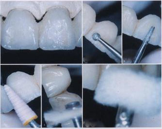 老虎牙能磨平吗,虎齿可以拔除吗