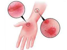 湿疹痒得要命,宝宝湿疹痒得难受怎么办