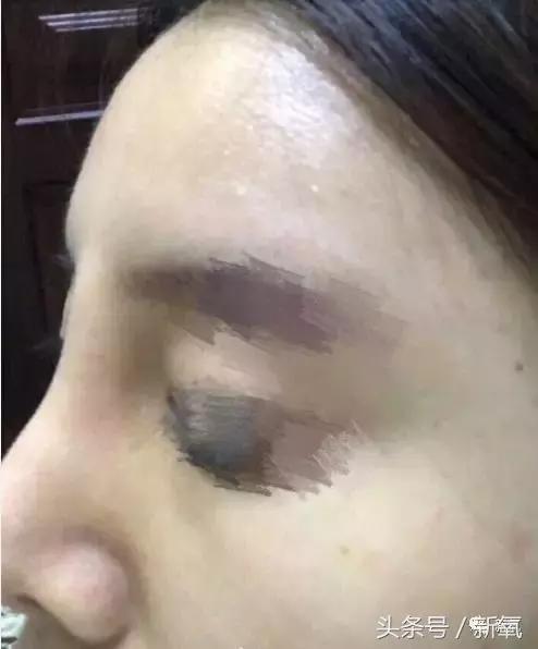 做了个达拉斯隆鼻,假体直接戳到脑门,我是不是和张檬、刘雨欣遇到了同一个医生!