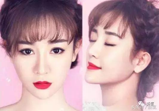 做了个达拉斯隆鼻,假体直接戳到脑门,我是不是和张檬、刘雨欣遇到了同一个医生!