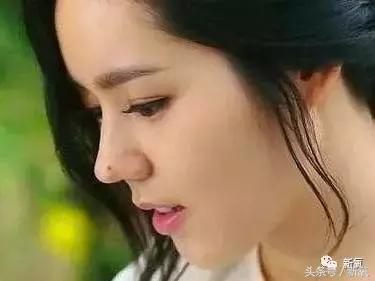 做了个达拉斯隆鼻,假体直接戳到脑门,我是不是和张檬、刘雨欣遇到了同一个医生!