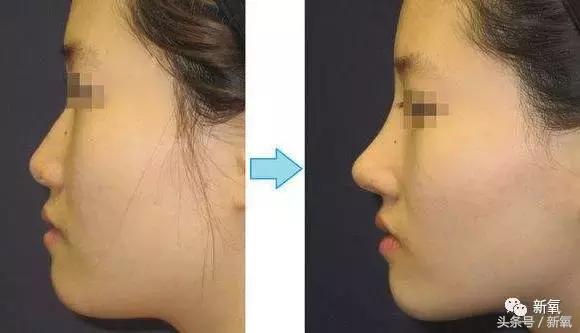 做了个达拉斯隆鼻,假体直接戳到脑门,我是不是和张檬、刘雨欣遇到了同一个医生!