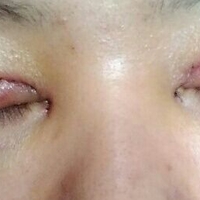 双眼皮松弛全切恢复过程,全切双眼皮几天可以洗脸