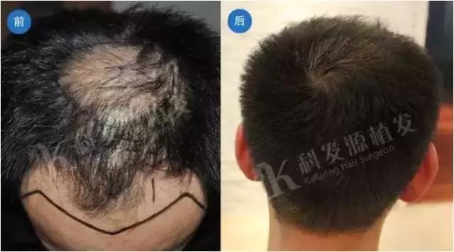 女性脂溢性脱发秃顶了,脂溢性脱发最终一定会秃顶吗