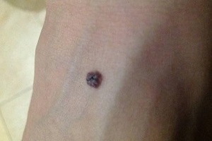 身上长一粒粒不痛不痒,突然之间长了一颗黑痣不痛不痒