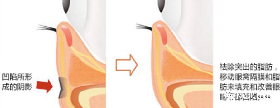 严重黑眼圈的治愈经历,千年黑眼圈解决方案