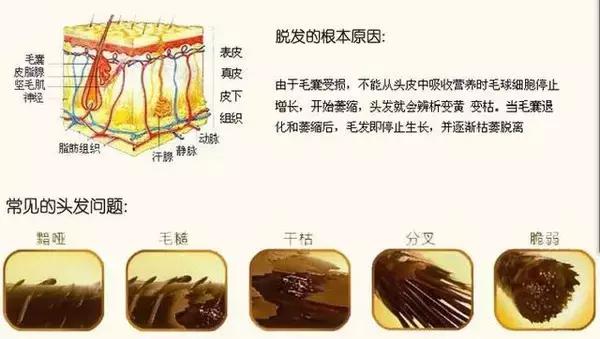 女性脂溢性脱发秃顶了,脂溢性脱发最终一定会秃顶吗