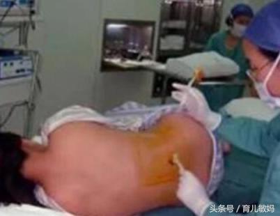 剖腹产41天向前摔了一下有事吗,剖腹产后第二天起床就头晕头疼