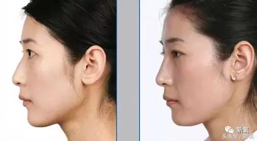 做了个达拉斯隆鼻,假体直接戳到脑门,我是不是和张檬、刘雨欣遇到了同一个医生!