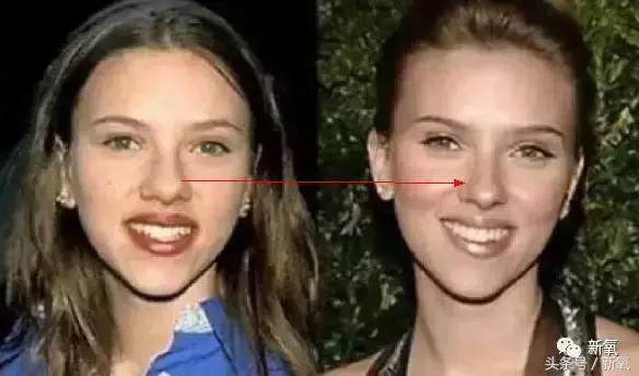 做了个达拉斯隆鼻,假体直接戳到脑门,我是不是和张檬、刘雨欣遇到了同一个医生!