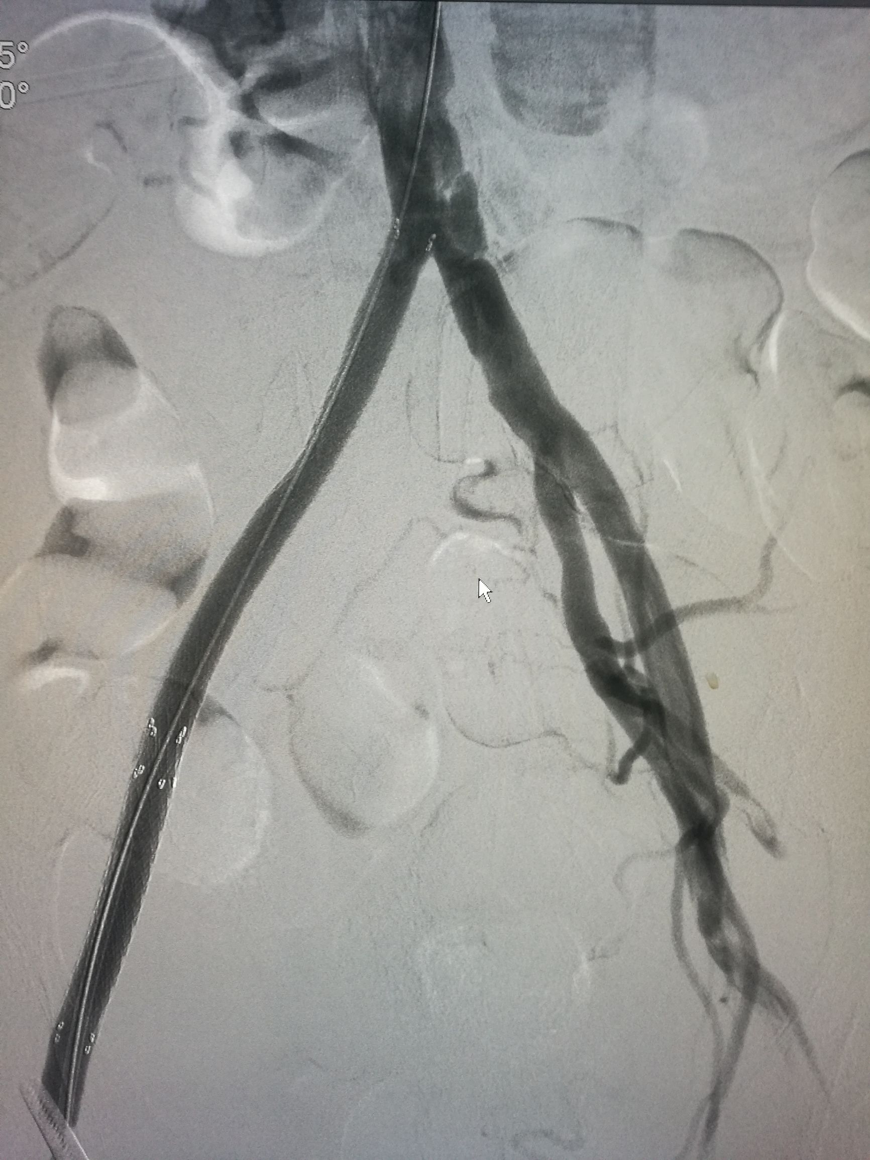 治下肢血栓闭塞脉管炎中药方,下肢动脉慢性血栓闭塞