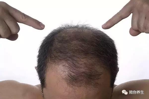 头发少秃顶适合什么发型,头顶头发稀少怎么办剃光头