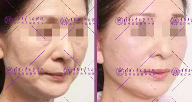 激光夏天做还是冬天做比较好,激光夏天做好还是冬天做好